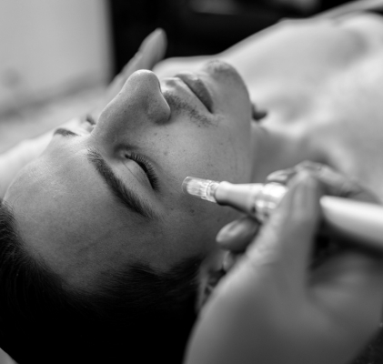 Cartucce Needling